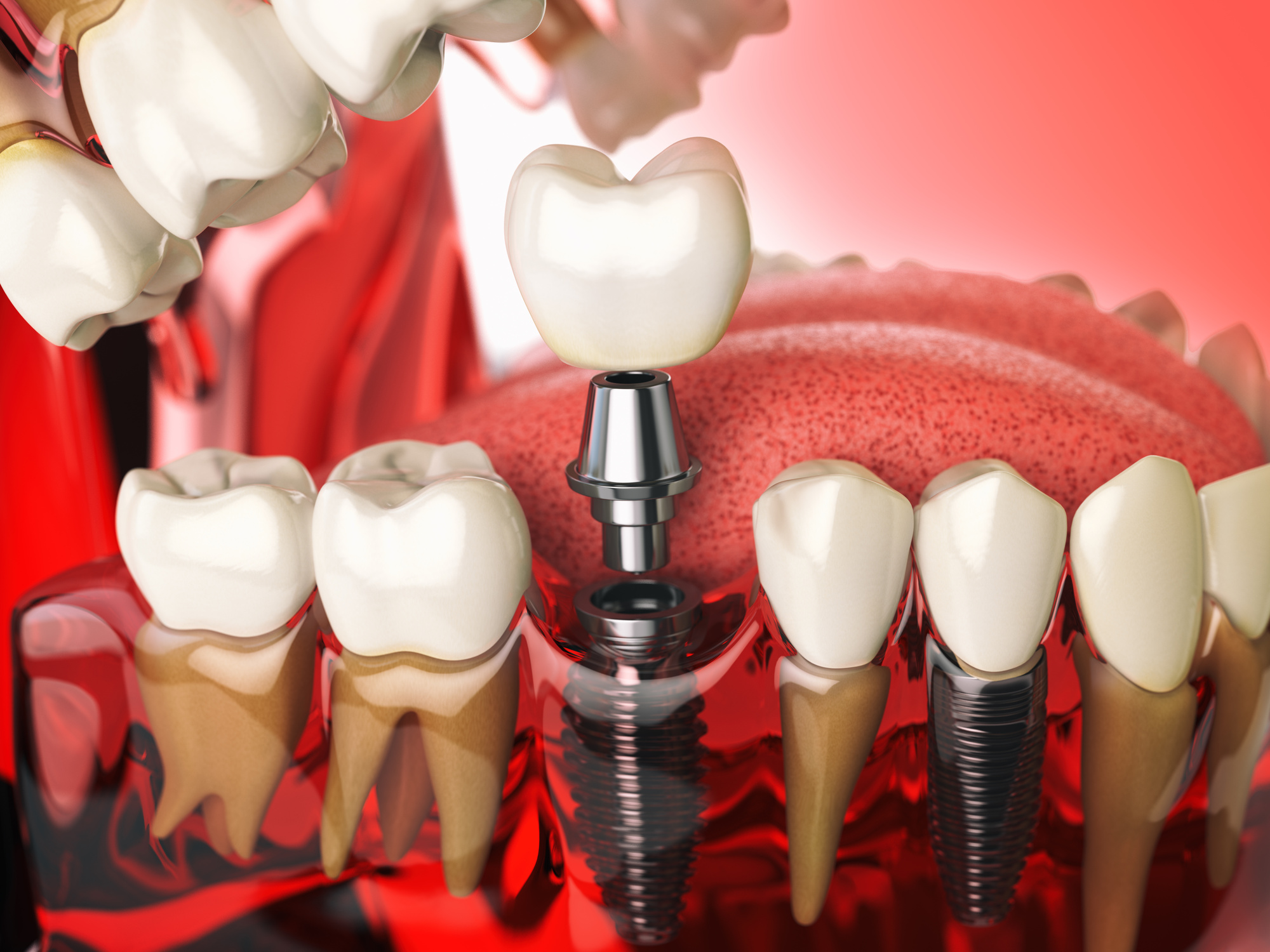how long does dental implant surgery take