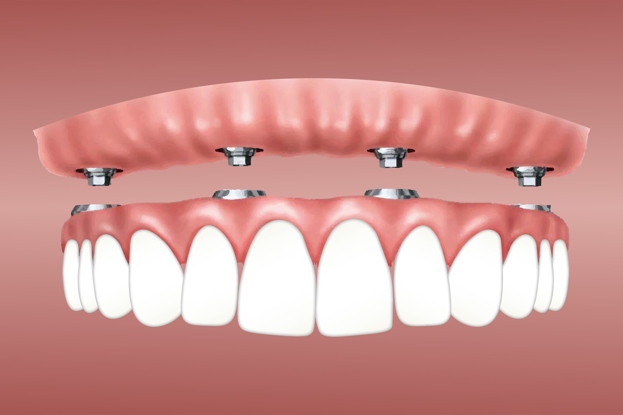 What Are Implant-Supported Dentures and Are They Right for You?