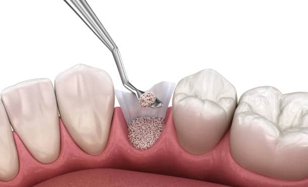 Bone graft placed in tooth socket for dental implant preparation.